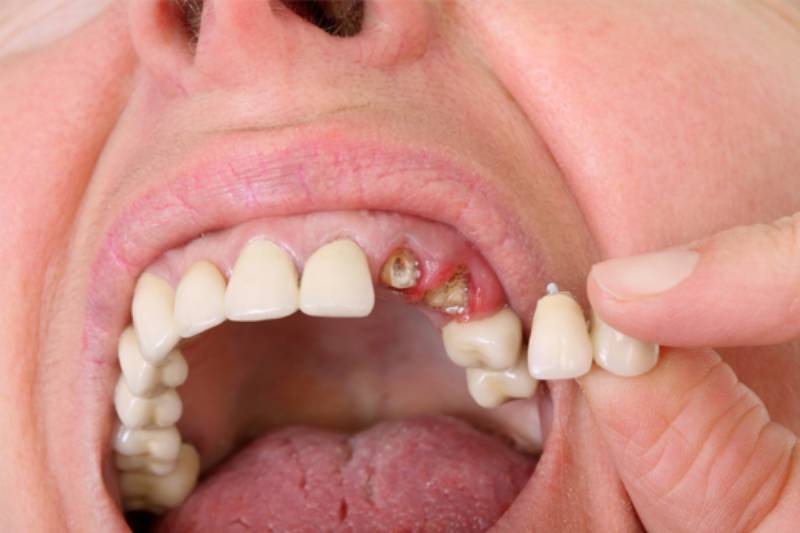 Nằm Mơ Thấy Rụng Răng Đánh Số Gì? Con Số “Vàng” Theo Dân Gian 1 Giấc mơ thấy rụng răng có ý nghĩa gì trong tâm linh và đời sống?